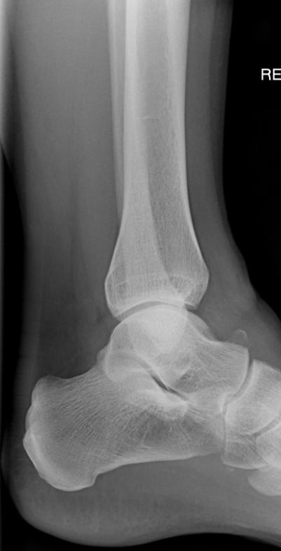 Xrays of ankle