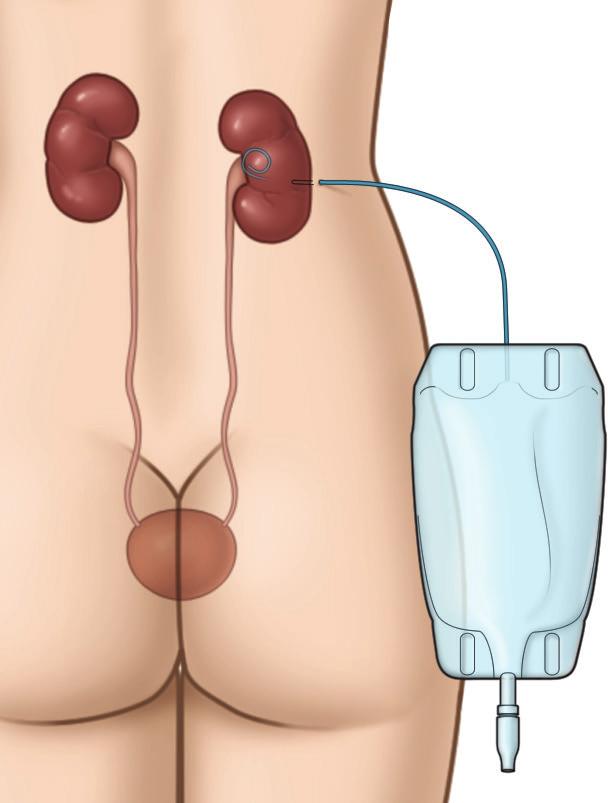 Bladder Conservative stone treatment Most kidney or ureteral stones will leave your body while you urinate.