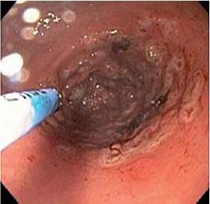 Gastric Antral Vascular Ectasia Therapy Indicated for bleeding Medical treatment?