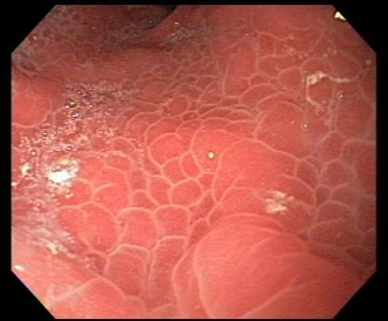 fundus and body Bleeding responds to measures that reduce portal