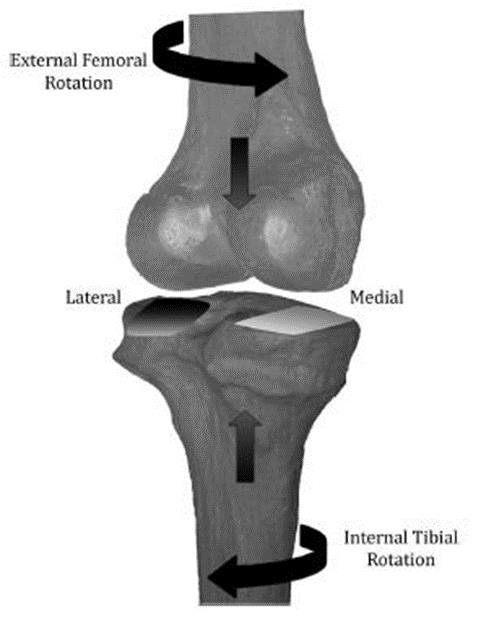 likely to cause external rotation of the femur and internal rotation of the tibia because the lateral femoral condyle slips off the tibial plateau which leaves the contact point between the medial
