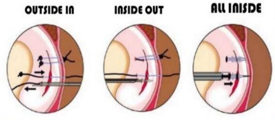 outcomes of partial meniscectomy procedures are overall positive, studies have shown that they result in accelerated degenerative changes at the knee 95.