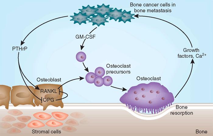Interactions between tumor cells and the bone