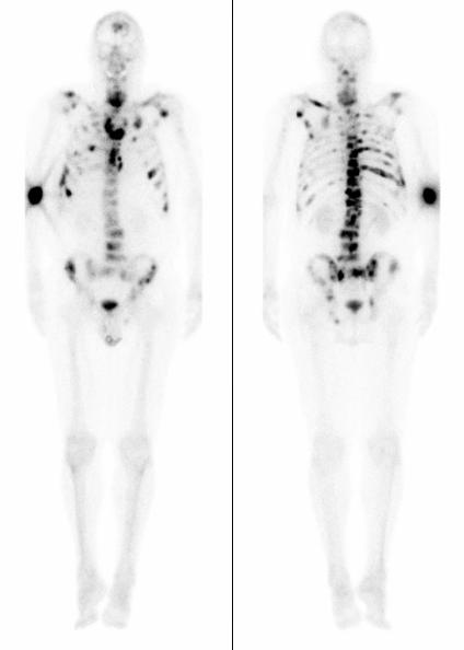 Spinal cord compression Bone marrow compromise