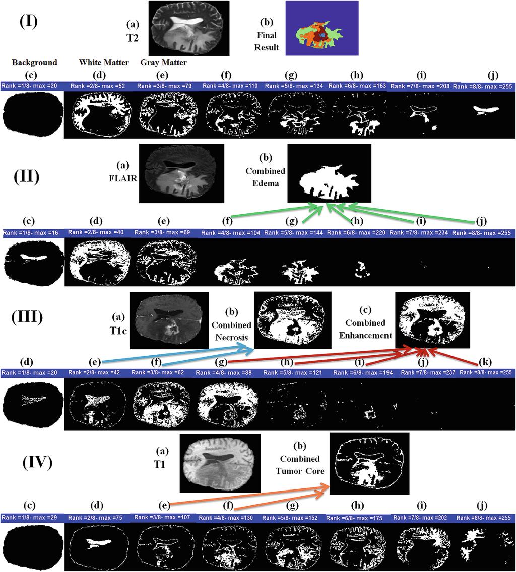 9 Interactive Semi-automated Method Fig. 3. High Grade Glioma Case 2. The t2 image (I-a) and its 8 segments ((I-c) (I-j)) are produced by NMF-LSM.