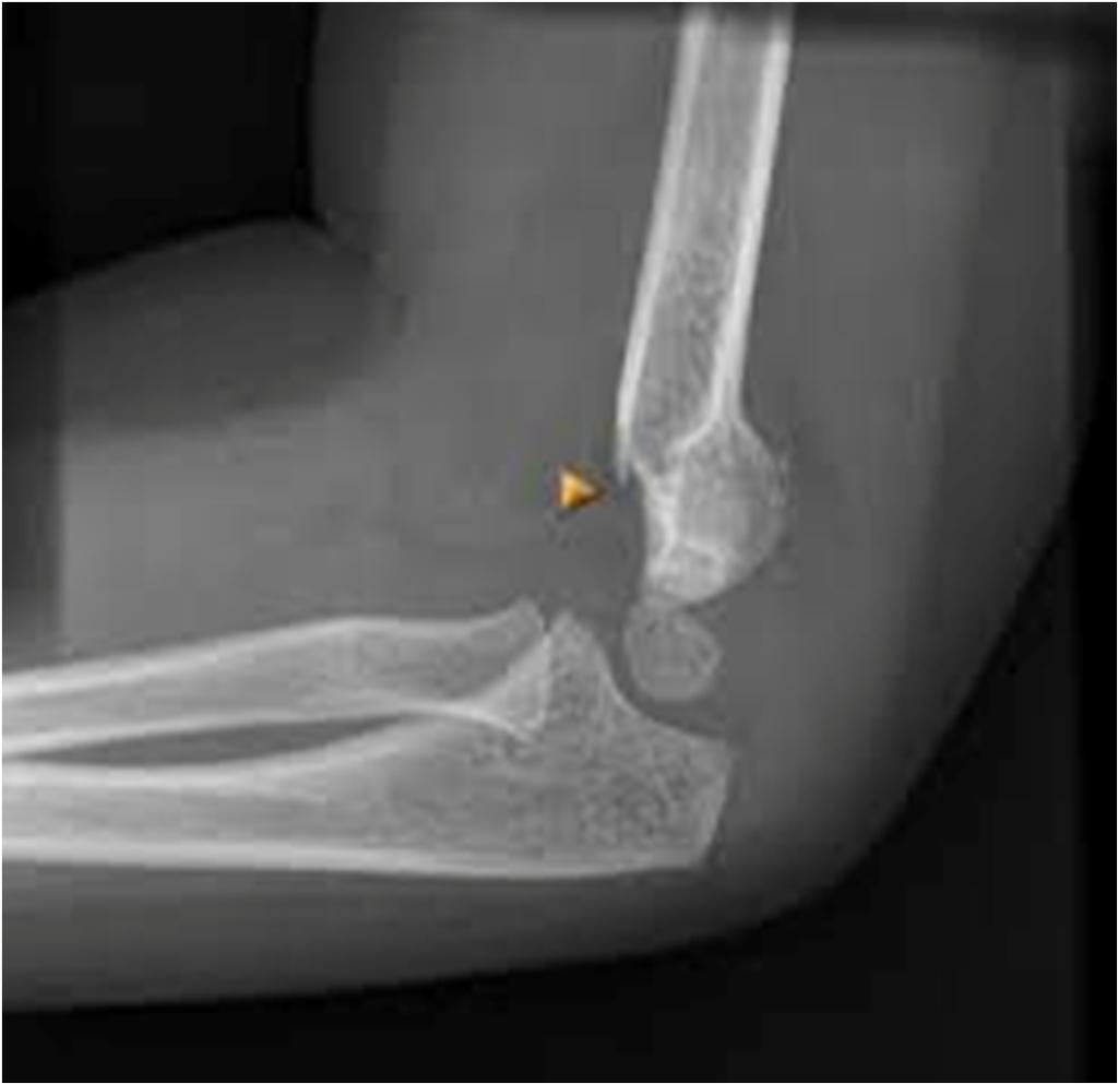 Supracondylar Fracture- Type 3 Disruption of anterior and