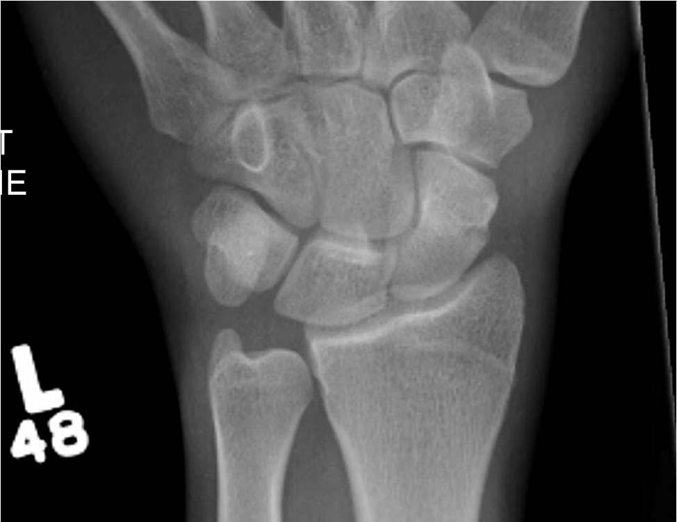 Scaphoid Fracture- Radiographic Findings - Usually normal -
