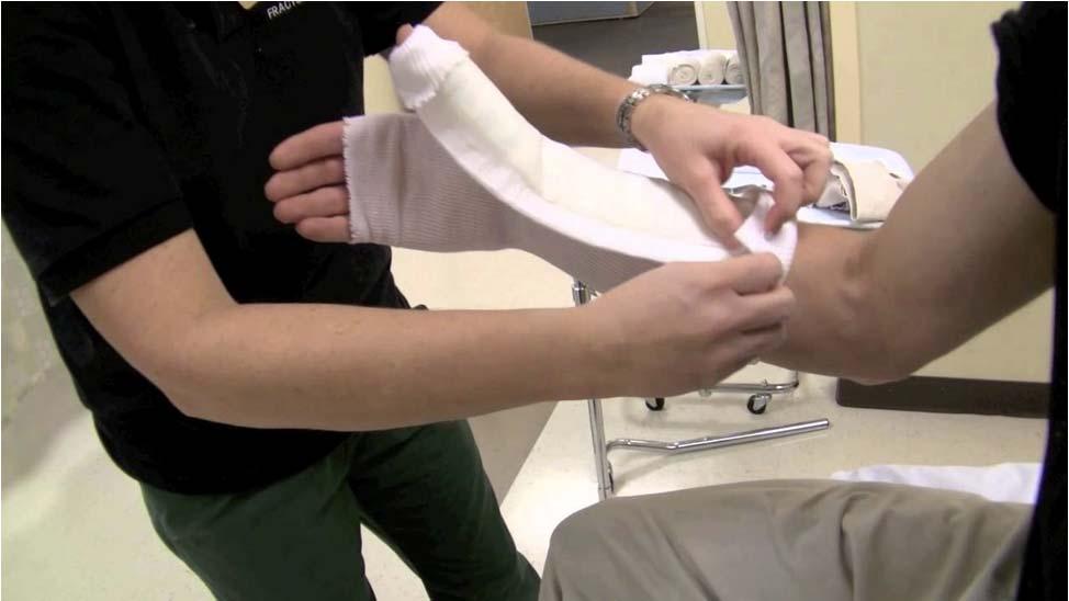 Scaphoid Fracture- Management Splint using a thumb spica Referral to orthopedics