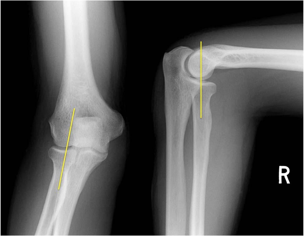 Nursemaid s Elbow- Radiographic Findings - Not needed unless diagnosis is in