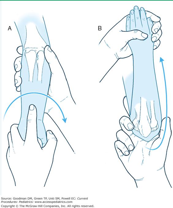 Nursemaid s Elbow- Reduction Flexion with hypersupination Extension with pronation Make sure to have a thumb