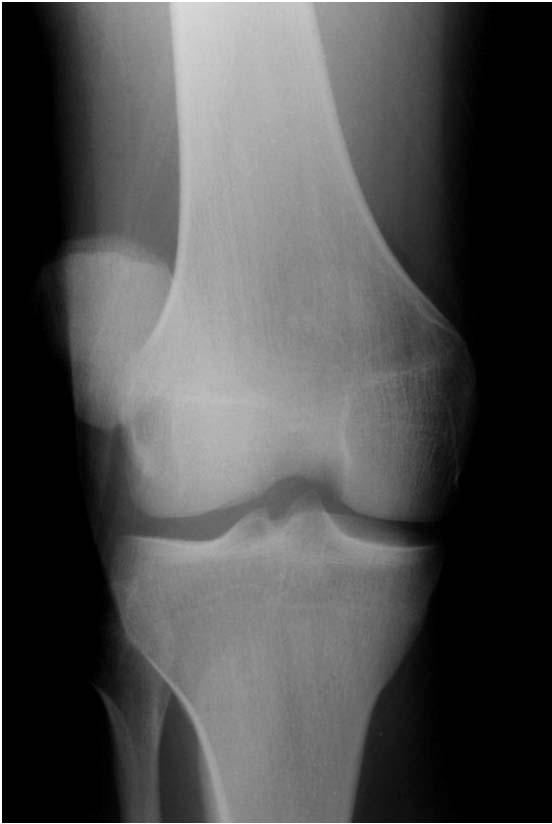 Patellar Dislocation- Radiographic Findings Radiographs are not