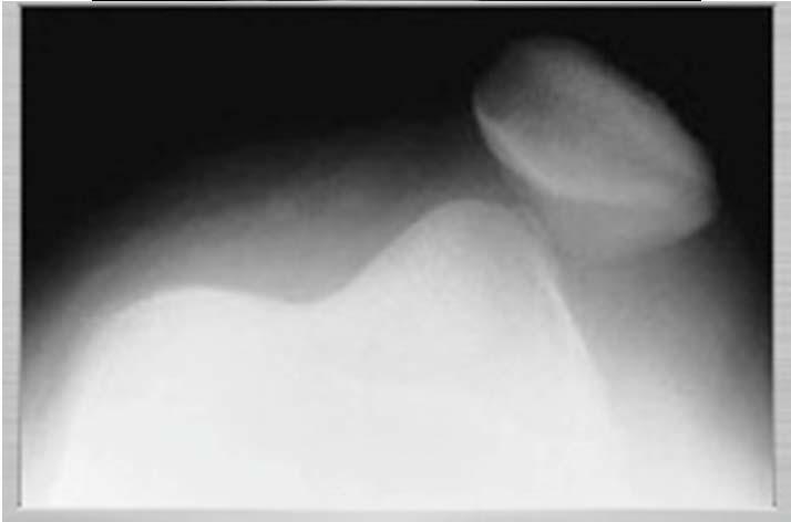 radiographs to evaluate for osteochondral fracture of the