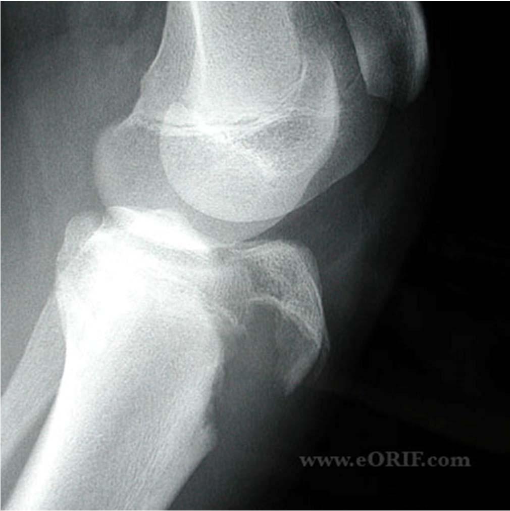 OSD- Radiographic Findings Not typically indicatedwill be normal early in the course May appear more frayed if prolonged