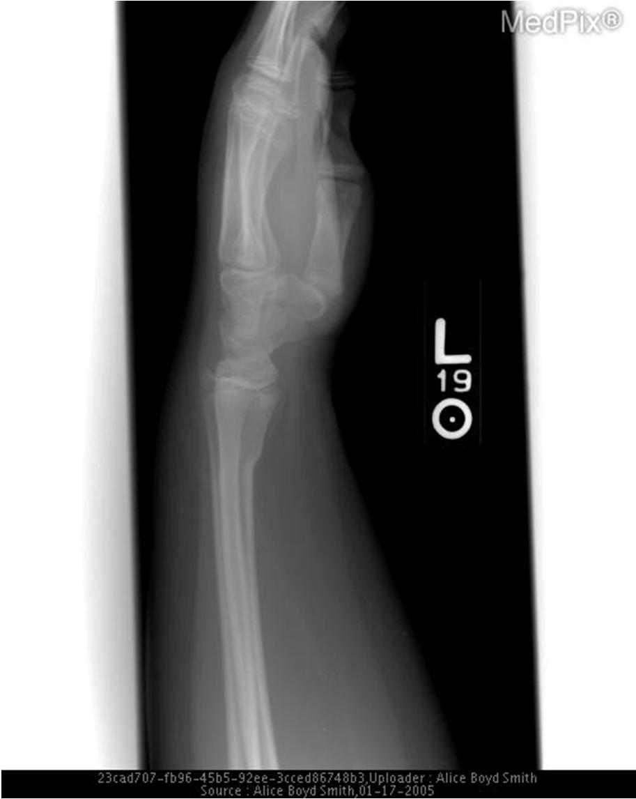 Buckle Fracture- Radiographic Findings Buckling of the