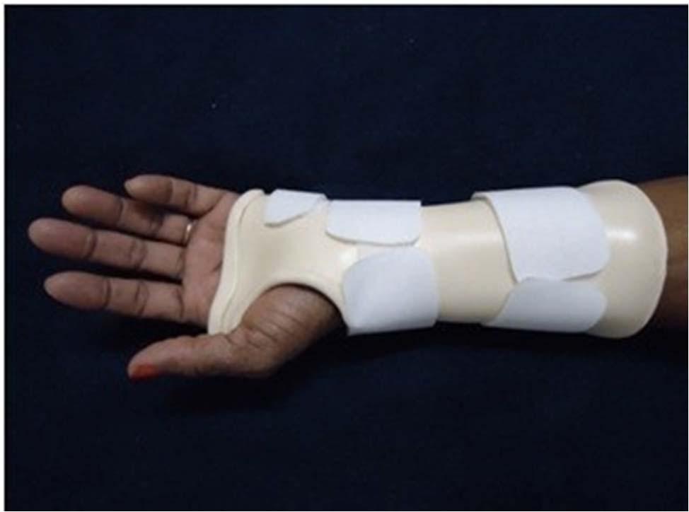 Buckle Fracture- Management Prefab wrist splint for 3-4 weeks No need for orthopedics referral (stable fracture)