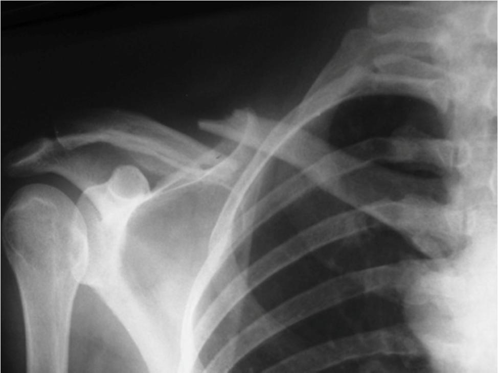 Clavicular Fracture- Radiographic Findings and Management Radiographic Findings Middle third is the most commonly injured