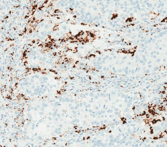 Scoring of VENTANA (SP142) Assay General guidelines Immunohistochemical (IHC) staining with