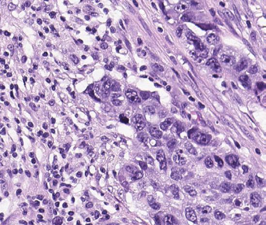 1: Moderate to strong circumferential TC membrane staining; NSCLC tissue, 20x Figure 2: Dark