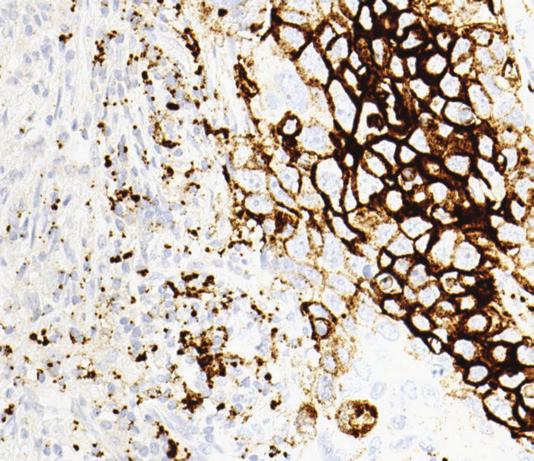 TC staining can be observed in association with IC  Review of the corresponding H&E slide