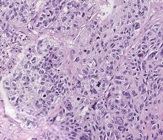 encountered in clinical practice, when TC and IC staining is observed together.
