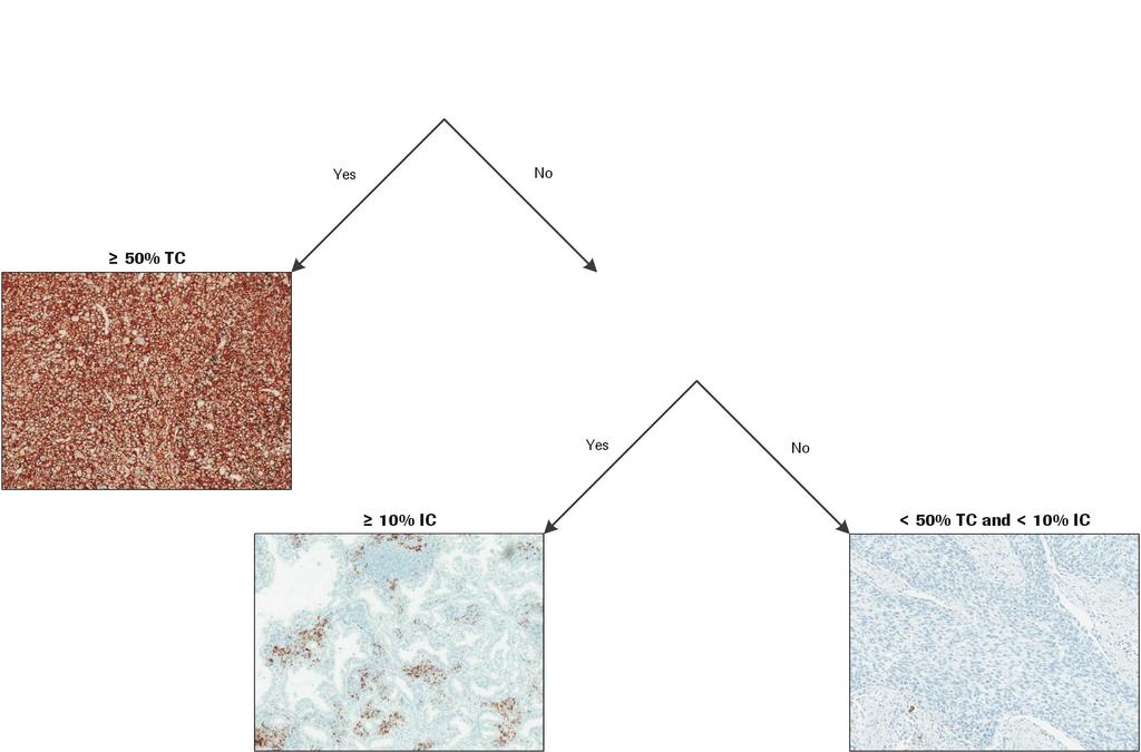 VENTANA (SP142) Assay scoring approach NSCLC NSCLC tissue stained with the VENTANA (SP142) Assay will be scored using a stepwise approach according to the criteria outlined in Table 1.