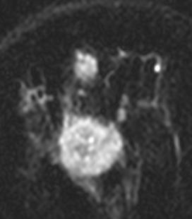 The high T2 signal does not match in size and shape to the dark central cavity on the post contrast T1 weighted image.