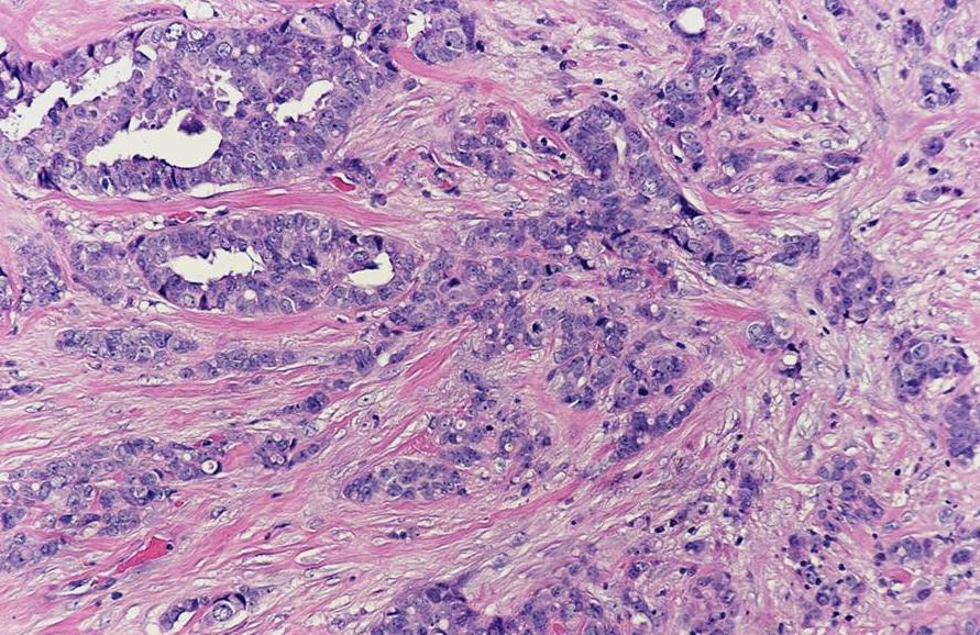 Rad-Path Concordance Malignant Invasive ductal carcinoma: mass or NME, variable distribution, clumped or heterogeneous internal