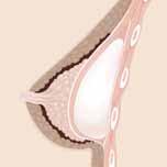 An incision is placed along the crease below the breast. This is the most widely used method. 2. Periareolar. An incision is made along the border of the areola, beside the nipple. 3. Transaxillary.