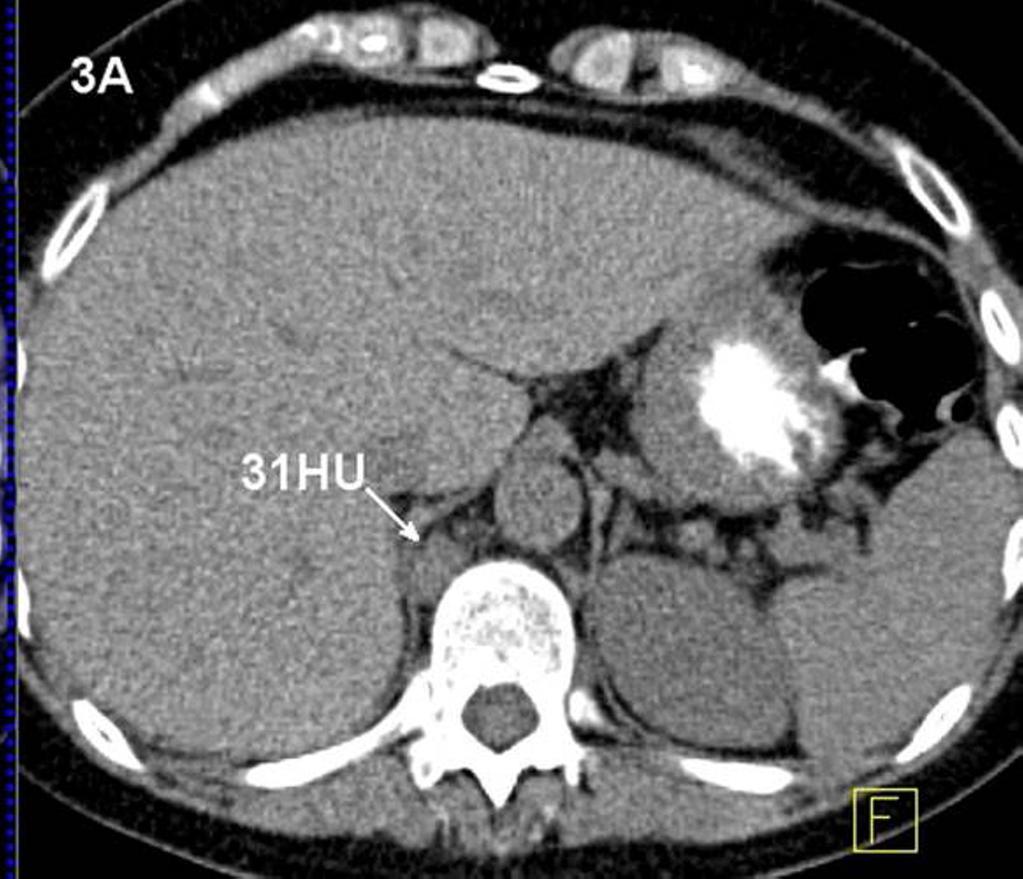 Figure 3. Comparison case of a patient with a history of rectal carcinoma. A, Non-enhanced CT of abdomen shows a 2 cm retrocrural lymph node (arrow) with a mean attenuation of 31 HU.