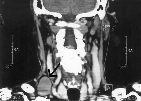 841 Hung-Jen Wang, et al Follow-up abdominal CT scans showed total regression of retroperitoneal lymphadenopathy (Fig. 2B).
