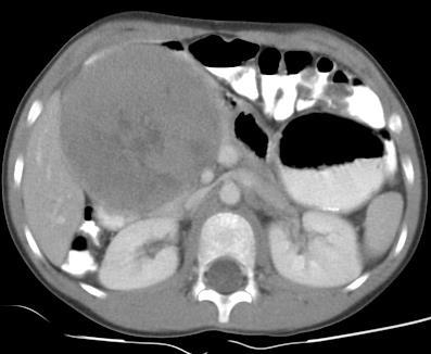 Case Example 1 20 year old female Gastroschisis SPEN tumor of pancreas Status post Whipple