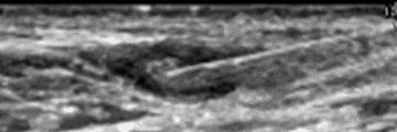 Technique Ultrasound guided placement of 22-25 gauge needle into inguinal