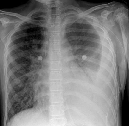 Case 3: Management Sirolimus Placement of a Denver shunt Coiling of left