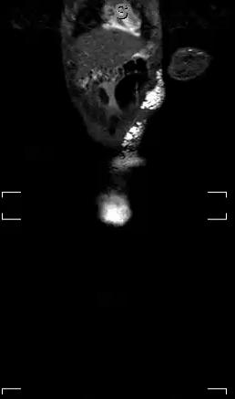 Case 4: Imaging 6 year old girl with progressive swelling of the left flank and perineum