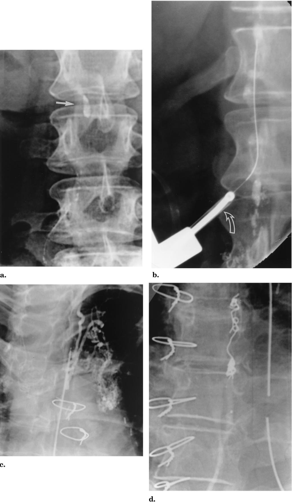 1142 Treatment of Chylothorax by Lymphatic Embolization and Disruption November 2002 JVIR After local anesthesia was administered, a midline puncture was made 5 10 cm below the xiphoid cephalad to
