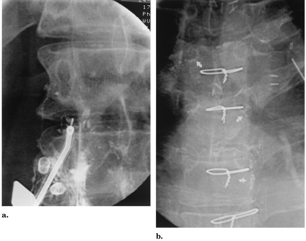 Volume 13 Number 11 Cope and Kaiser 1143 Figure 3. Lymphatic needle disruption in a patient who had undergone coronary artery bypass graft placement and developed high-output left-sided chylothorax.