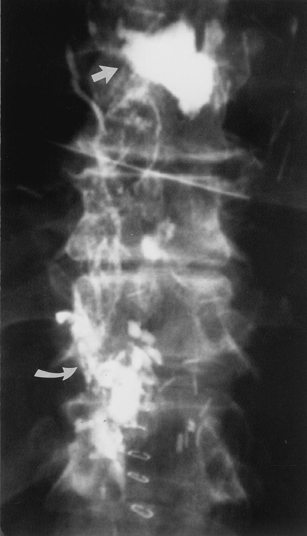 1144 Treatment of Chylothorax by Lymphatic Embolization and Disruption November 2002 JVIR Figure 4.