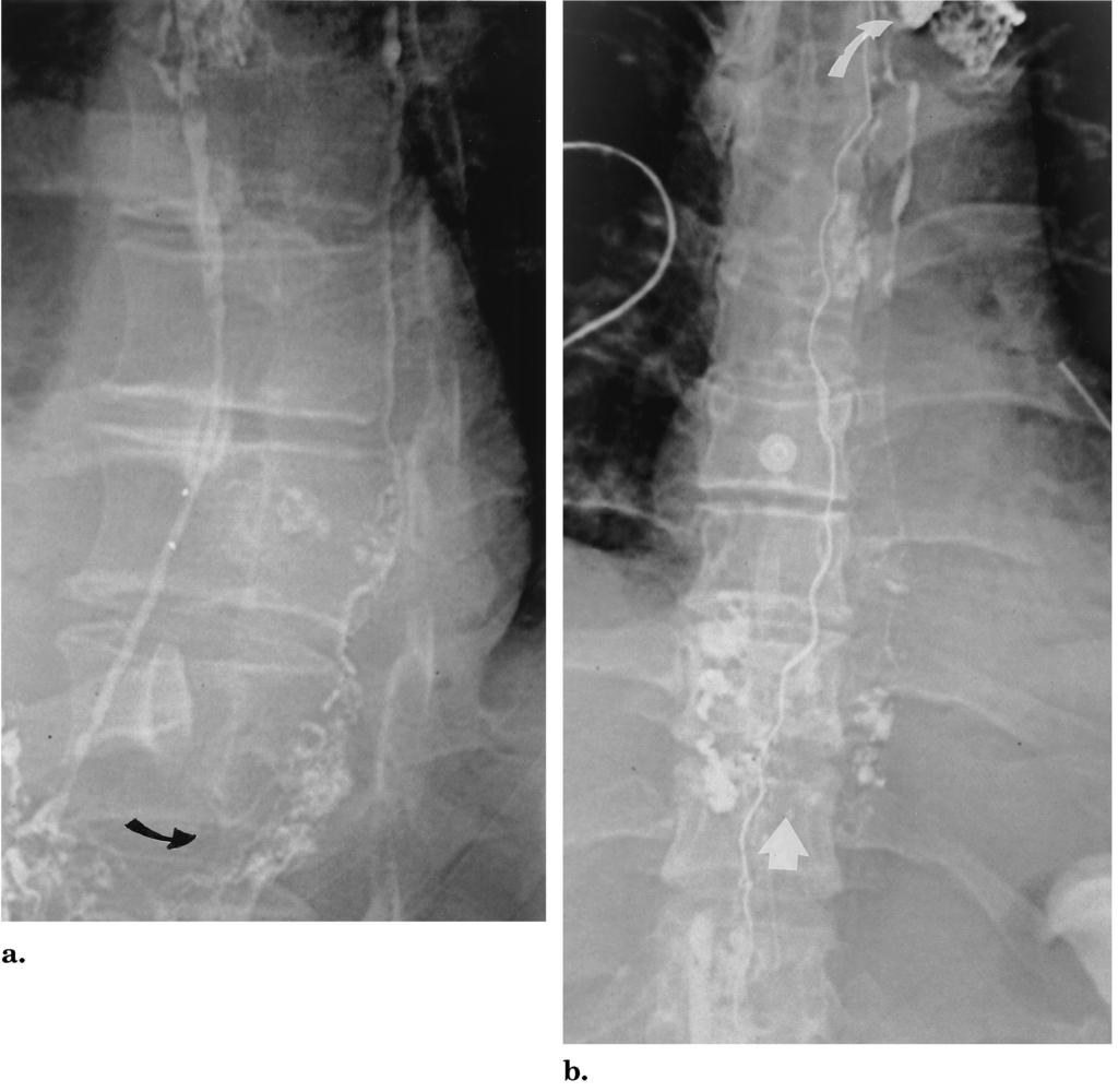 1146 Treatment of Chylothorax by Lymphatic Embolization and Disruption November 2002 JVIR Figure 5.