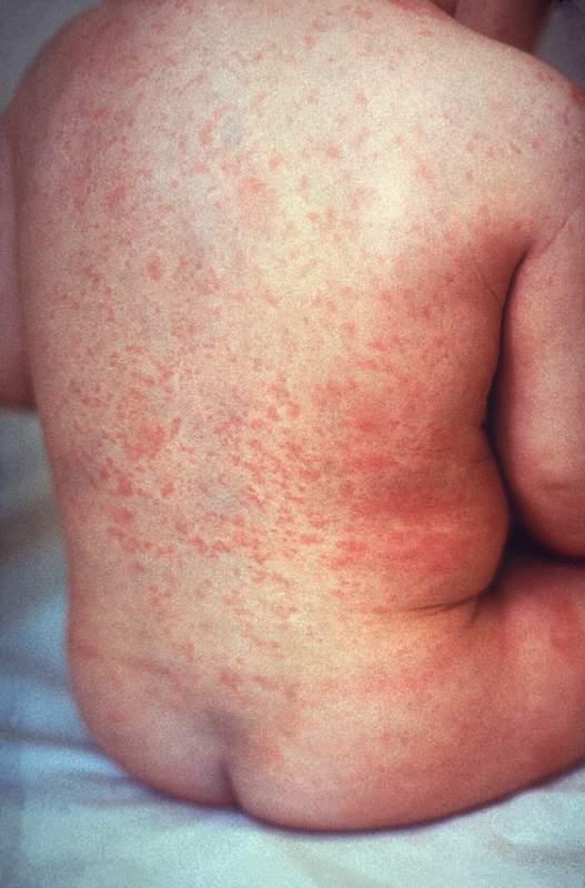 What is MMR? Measles An infection caused by a virus 95%+ used to catch it before 18.