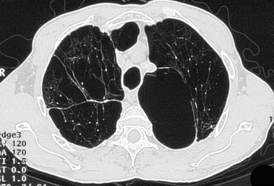 Emphysema Endoscopic lung volume