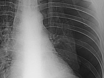 Patient with 4 valves in left upper lobe (Lingula bronchus included) International Endobronchial Valve for Emphysema PalliatioN Trial (VENT) Type of