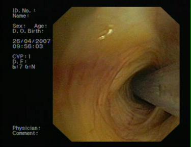 Presented at: World Congress of Bronchology, June 2002, Boston Silicone Spigots NOVATECH To stick the lobes Obstruction of emphysematous lobes with glue: Endobronchial injection through a
