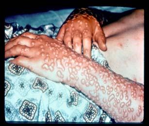Use dates back to 1796 Milkmaids who had cowpox (vaccinia) were immune to smallpox Jenners showed that inoculating