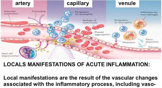 - artery capillary venule LOCALS MANIFESTATIONS OF ACUTE INFLAMMATION: Local are the result of the vascular changes associated with the inflammatory process, including vasodilation and increased