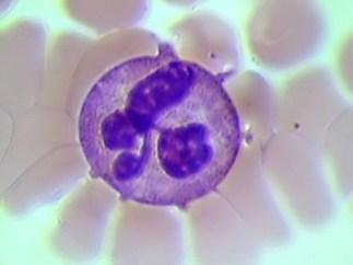 Cellular defence 1) Phagocytic cells: Neutrophile granulocytes (60-70%) Bacteria 2) NK-cells (natural killer