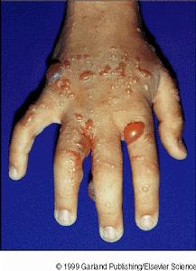 Myasthenia gravis, Graves disease) Immunodeficiency