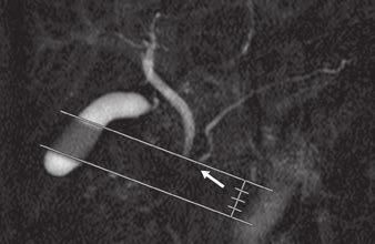 Spatially selective IR pulse with 2-mm width was placed on area between parallel white lines (tagged area). Note scale is divided into four regions for secretion grade.
