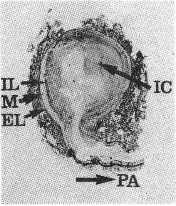Beyond this point the muscular wall gradually became elastic, until within the lung parenchyma the wall structure was that of an elastic pulmonary artery (Fig. 7).
