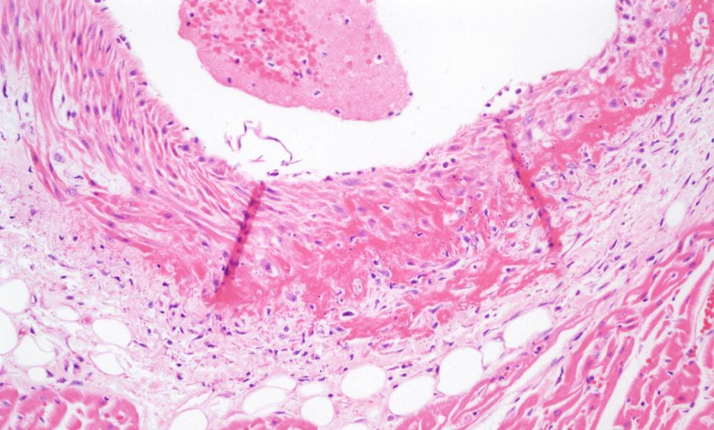 Fibrinoid Necrosis VASCULAR SYSTEM NECROSIS / VASCULITIS Refers to the vascular necrosis with the microscopic deposition of acidophilic proteinaceous