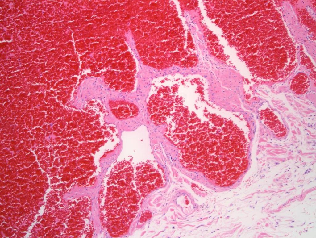 TUMOURS OF THE CARDIOVASCULAR SYSTEM Hemangioma